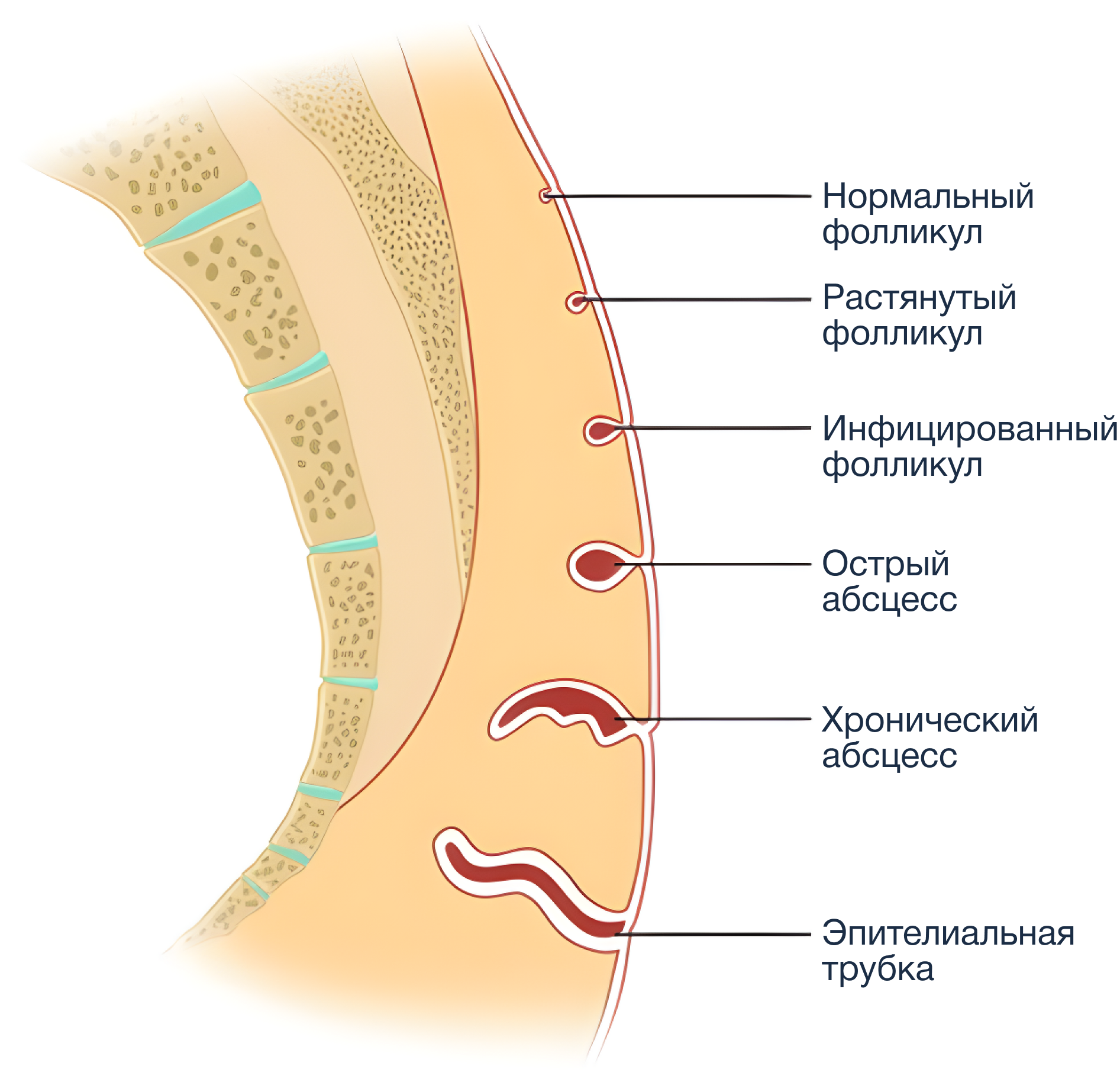 База знаний | Эпителиальный копчиковый ход