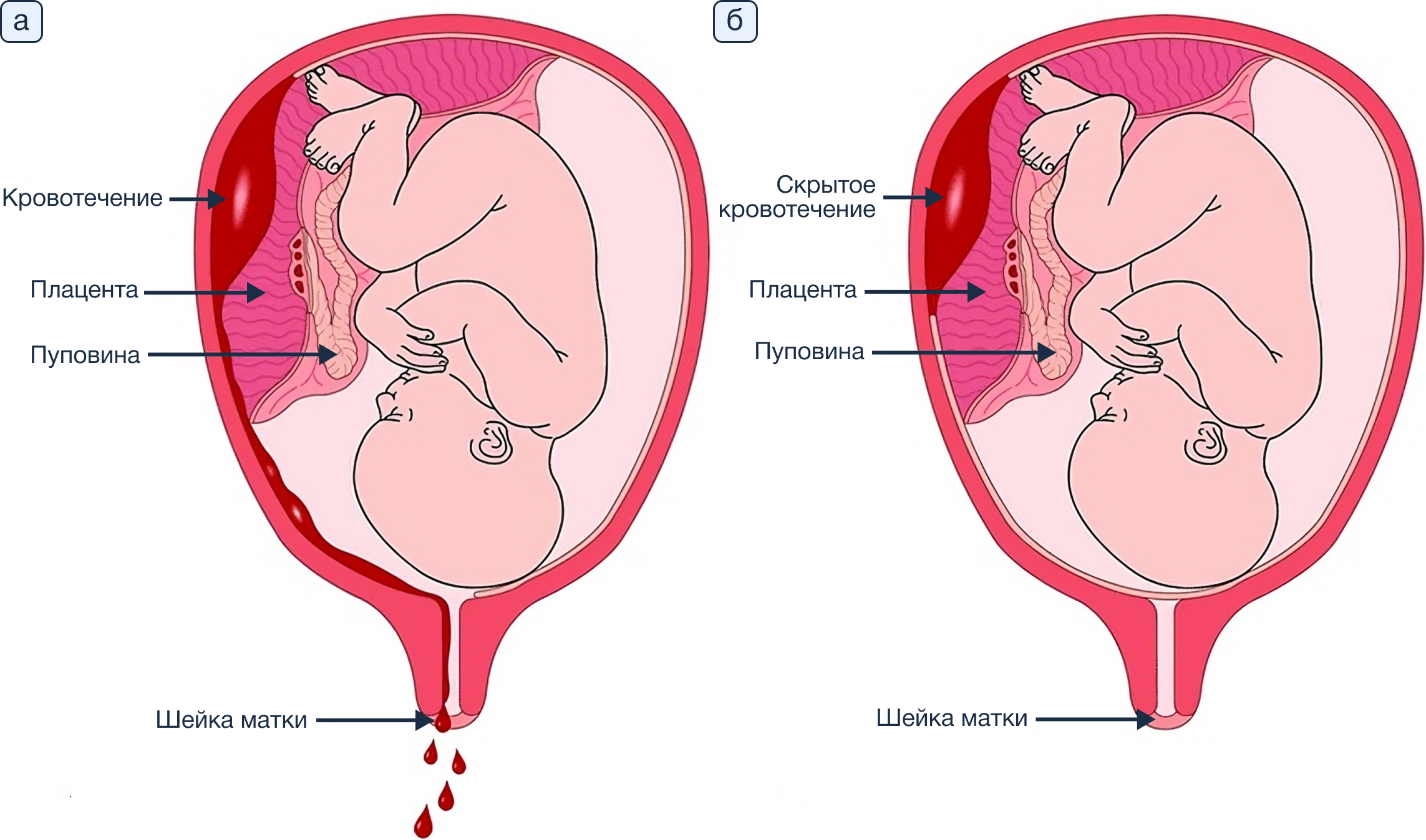 Кровь во втором триместре беременности. Второй триместр беременности. Беременность выделения.