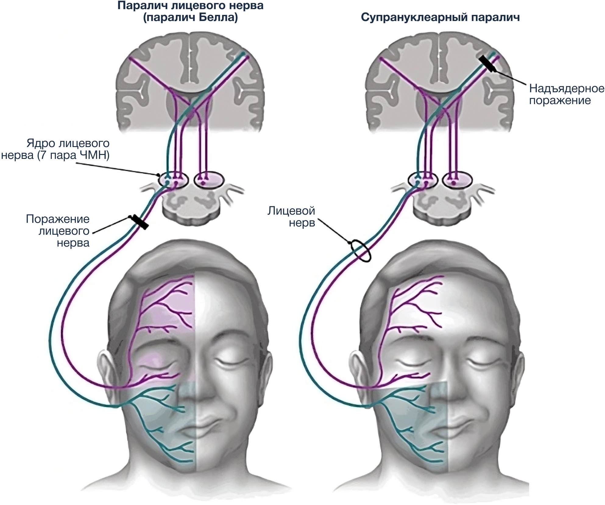 Центральный лицевой паралич. Периферический парез лицевого нерва патогенез. Неврит лицевого нерва Центральный и периферический. Неврит тройничного нерва мрт. Центральный и периферический парез лицевой мускулатуры.