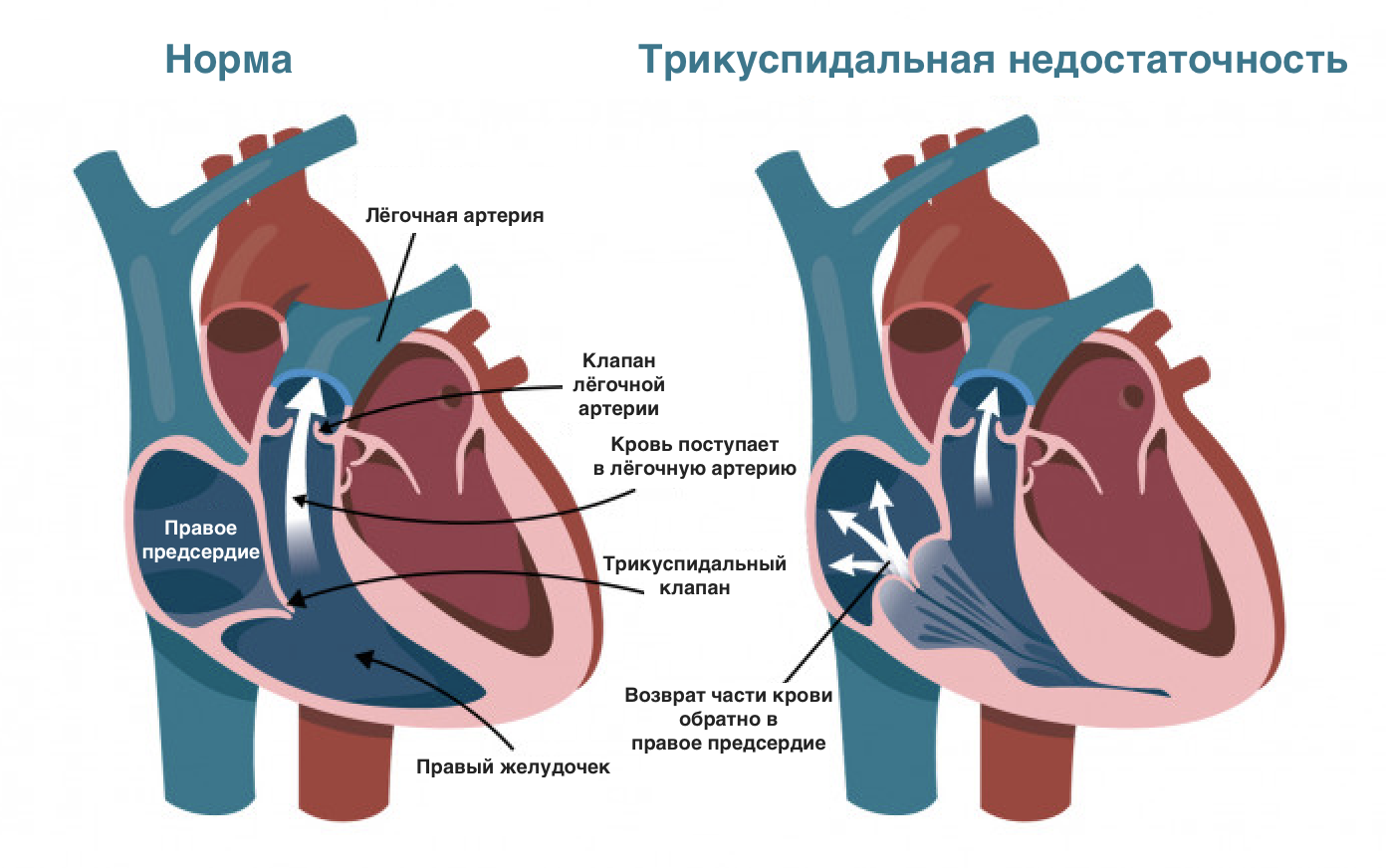 База знаний | Трикуспидальная недостаточность