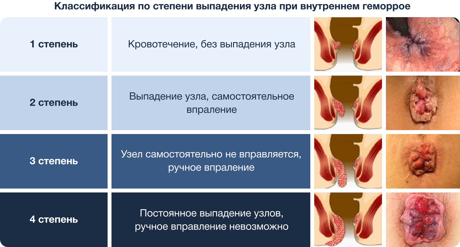 Лечение тромбоза геморроидального узла в Ростове-на-Дону | Клиника УРО-ПРО